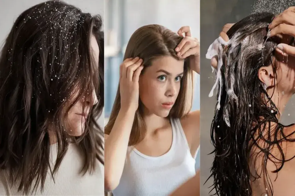 Which Anti Dandruff Shampoos Are Best For Itchy And Flaky Scalp?