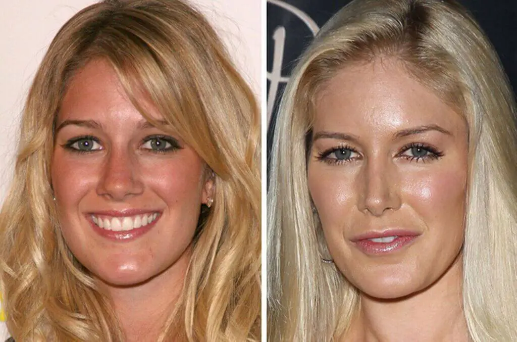 Celebrities Who Have Had Nose Jobs