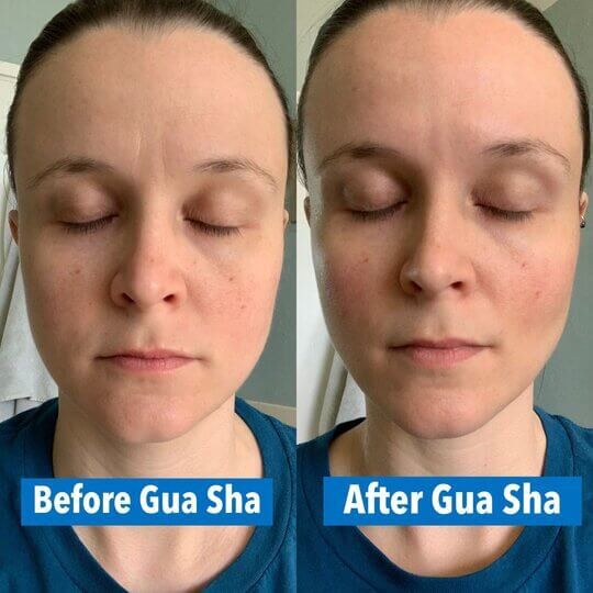 Gua Sha Help in Healing Skin Issues