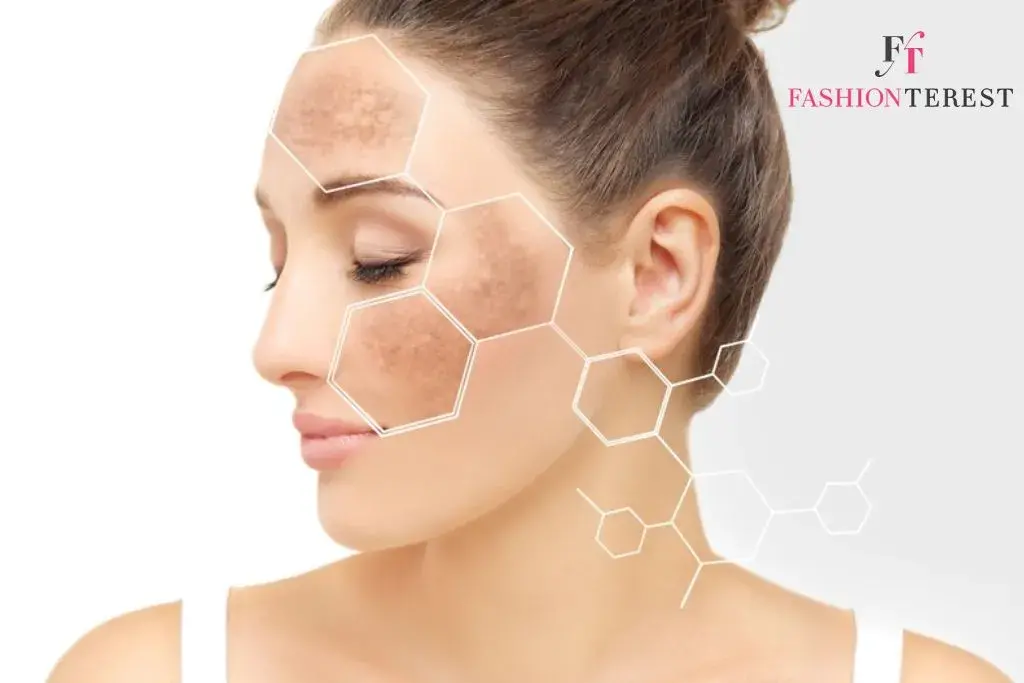 Hyperpigmentation Treatment: A Comprehensive Guide