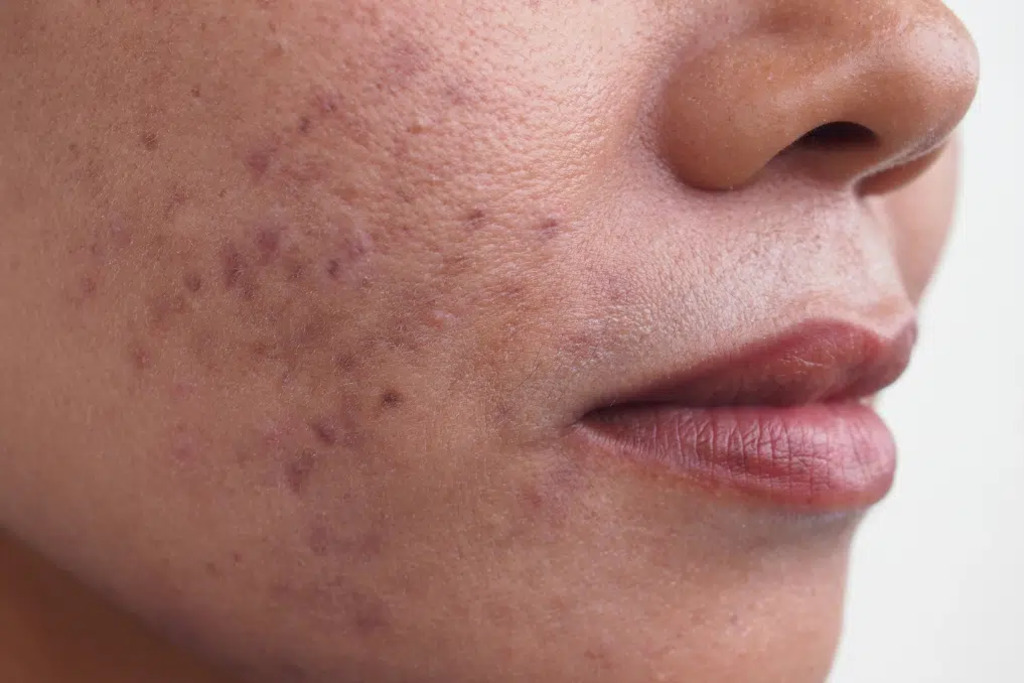 Causes of Hyperpigmentation