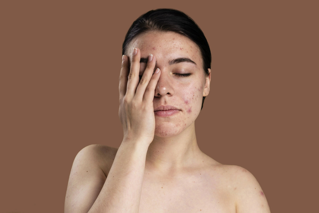 Home Remedies to Treat Hyperpigmentation