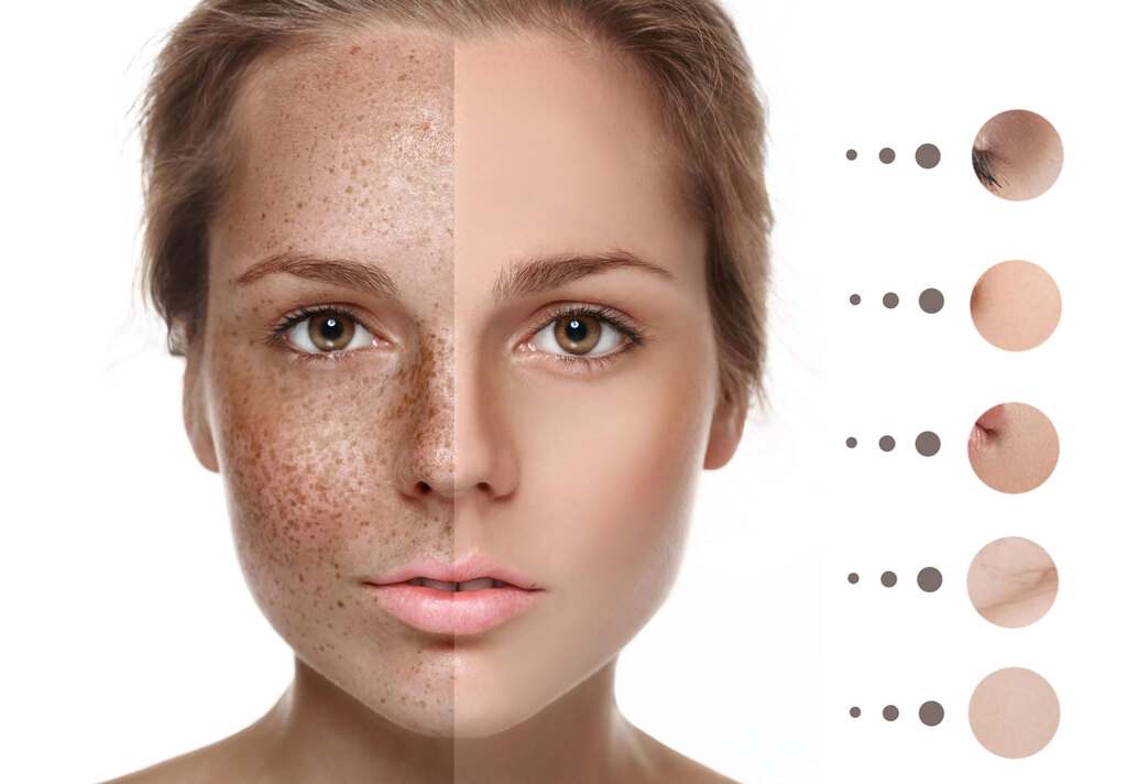 Types of Hyperpigmentation